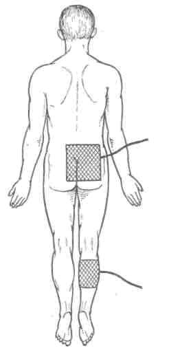 Расположение электродов при гальванизации и электрофорезе ноги