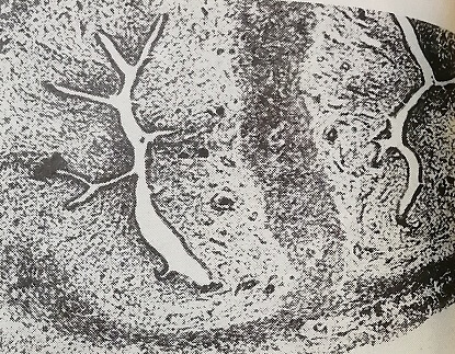 Атрофия эпителия слизистой полости матки при действии лазера