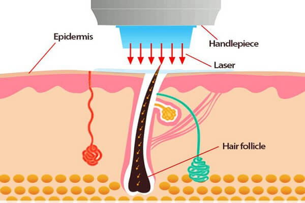 Принцип воздействия лазерного излучения на ткани