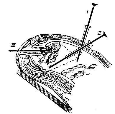 Схема положений (I, II, III) лапароскопа после прокола брюшной стенки