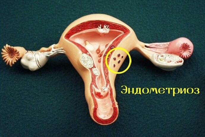 Как выглядит эндометриоз
