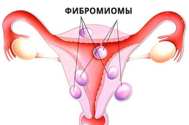 Как выглядят фибромиомы матки