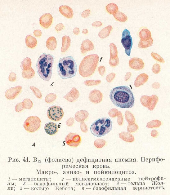 Фолиево-дефицитная анемия. Периферическая кровь