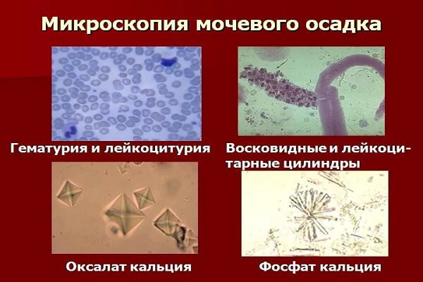Микроскопия мочевого осадка