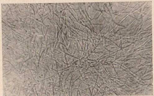 Микроскопическая картина кандидамикоза слизистой оболочки рта