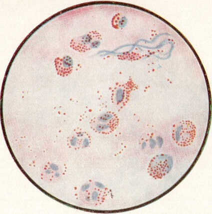 Эозинофильные лейкоциты в мокроте (масляная иммерсия)
