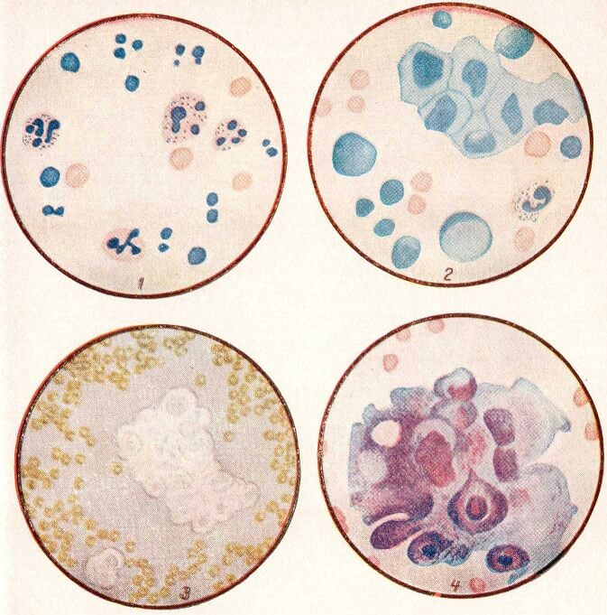 Клеточный состав транссудатов и экссудатов