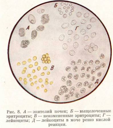 Эритроциты и лейкоциты в моче