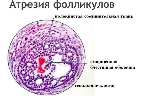 Принцип атрезии фолликулов