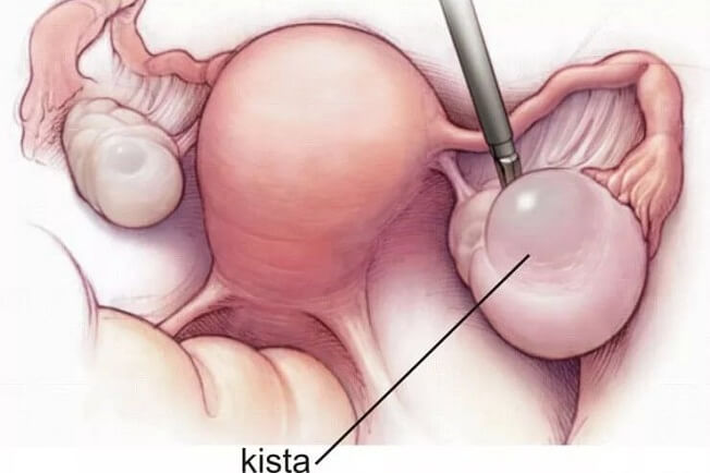 Как выглядит ретенционная киста