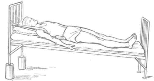 Положение больного на наклонной кровати с лямками