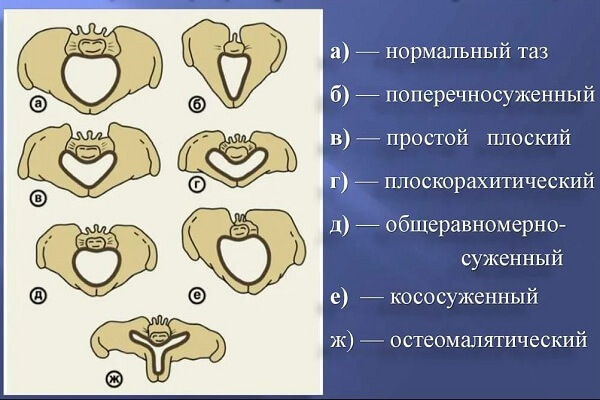 Виды узкого таза у женщин