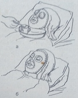 Наложение парафиновой маски на лицо