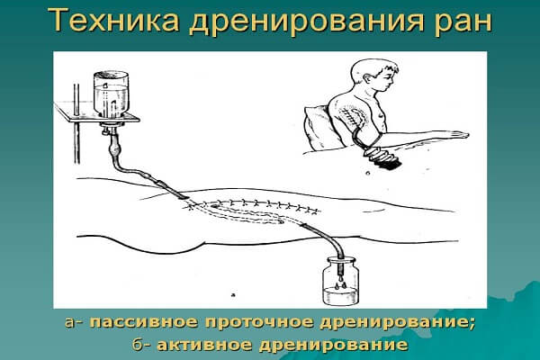 Техника дренирования ран долгое время совершенствовалась