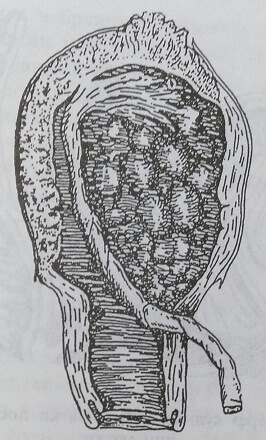 Placenta accreta с прорастанием ворсинок плаценты через стенку матки