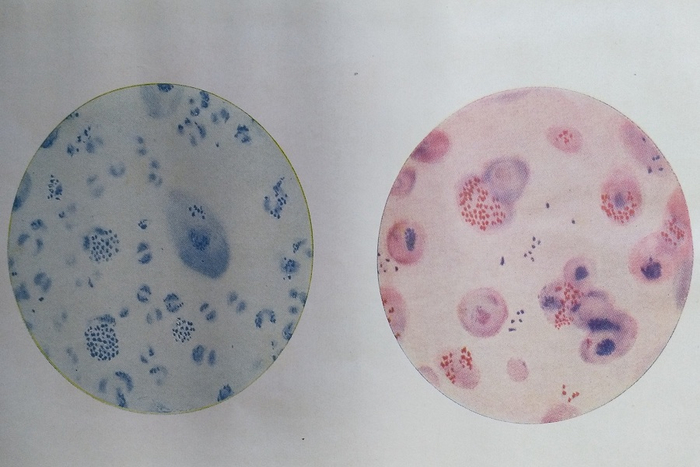 Микроскопическая картина гнойных выделений при гонорейном вагините