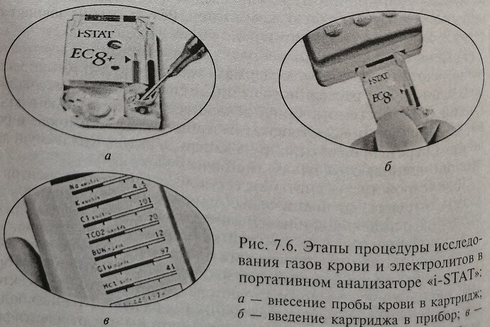 Этапы процедуры исследования газов крови и электролитов в анализаторе