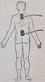 Продольная диатермия области позвоночника