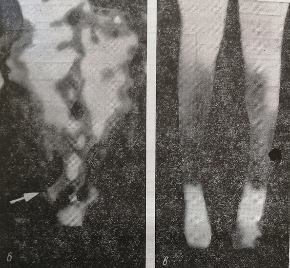Термограммы спины и ног пациента с пояснично-крестцовым радикулитом