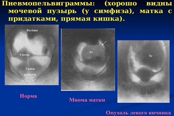 Примеры пневмопельвиграмм