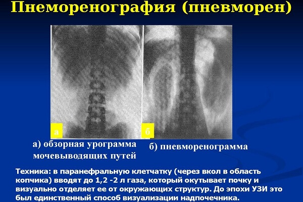 Сущность пневморенографии