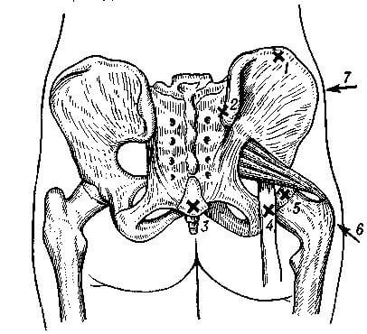 Схема болевых точек при ощупывании задней поверхности таза