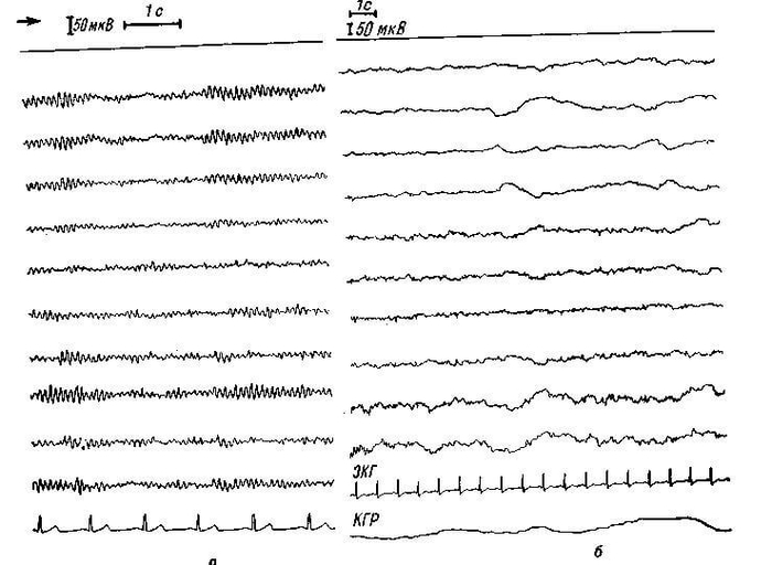 Электроэнцефалограмма (часть I)