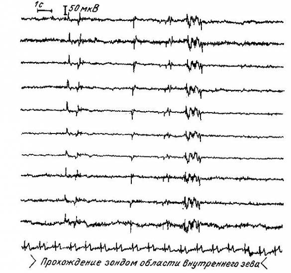 Электроэнцефалограмма (часть II)
