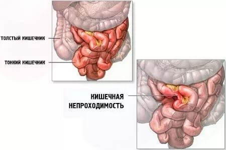 Внешний вид кишечной непроходиомсти