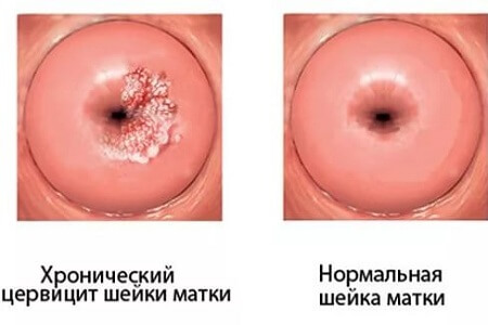 Как выглядит хронический цервицит шейки матки
