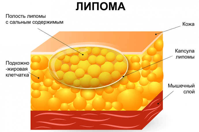 Структура липомы