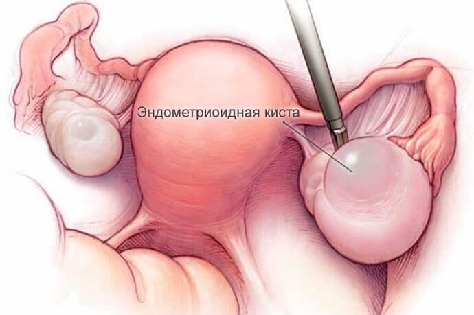 Яичник с эндометриоидной кистой