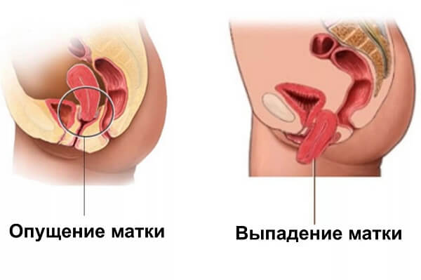 Опущение и выпадение матки