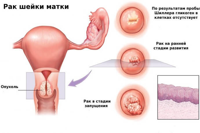 Диагностика рака шейки матки позволяет выявлять рак на ранней стадии