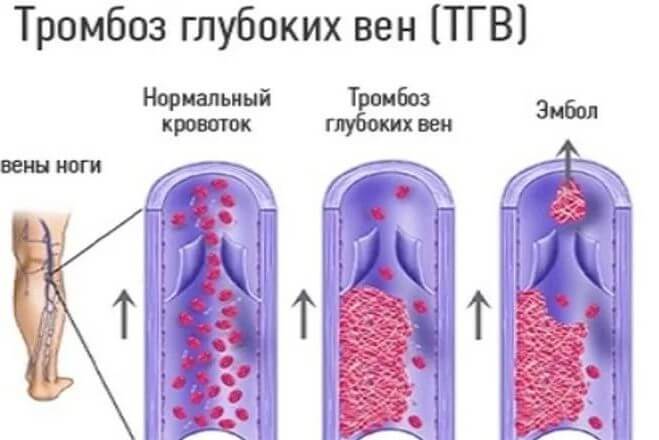 Тромбоз глубоких вен