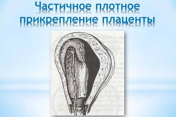 Частичное плотное прикрепление плаценты