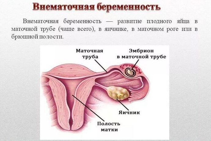 Сущность внематочной беременности