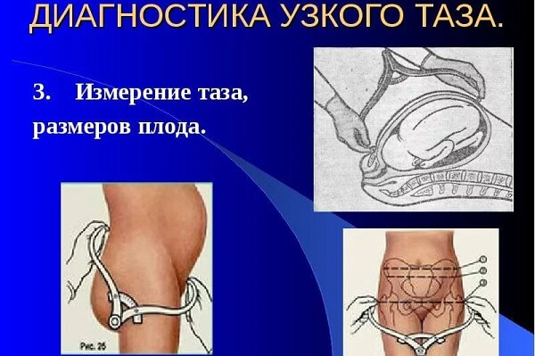 Диагностика узкого таза