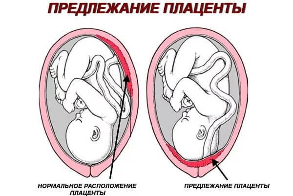 Предлежание плаценты