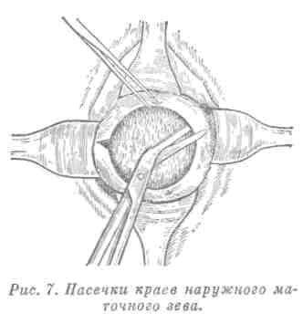 Насечки краев наружного маточного зева
