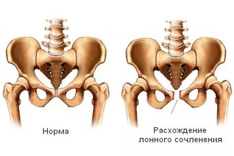 Пример разрыва лонного сочленения