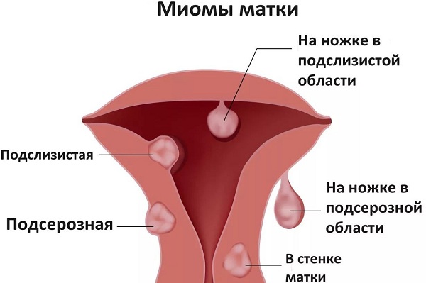 Виды миом матки