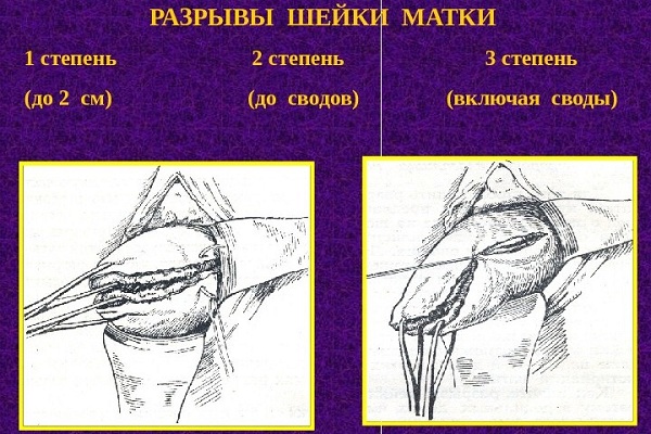 Пример разрывов шейки матки