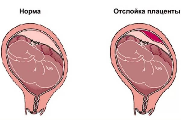 Принцип отделения плаценты