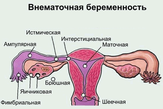 Сущность внематочной беременности