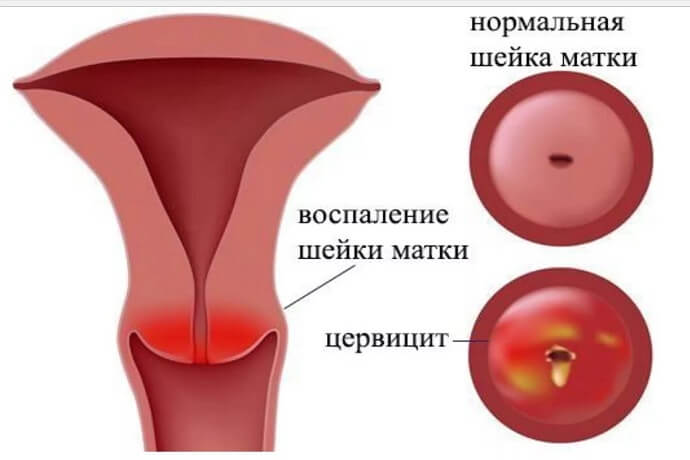 Что такое цервицит