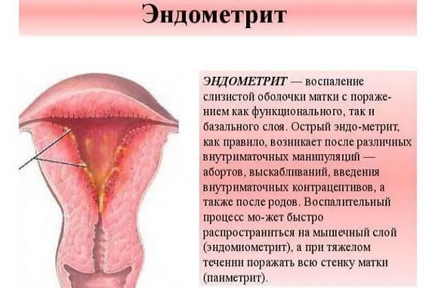 Что такое эндометрит