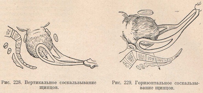 Вертикальное и горизонтальное соскальзывание щипцов