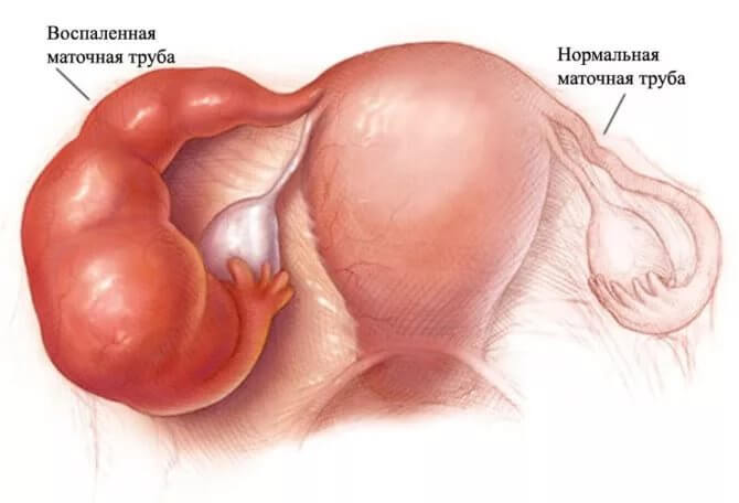 Сущность сальпингита