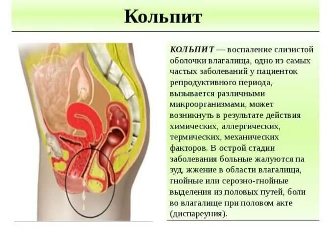 Что такое кольпит